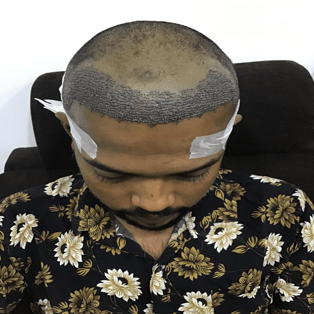 Hair Transplant After