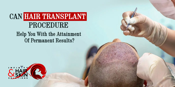 Can hair transplant procedure help you with the attainment of permanent results