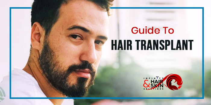Guide to Hair Transplant