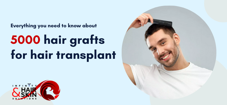 Everything you need to know about 5000 hair grafts for hair transplant