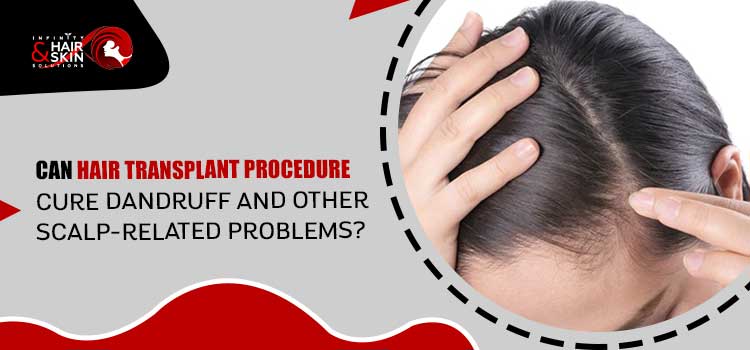 Can hair transplant procedure cure dandruff and other scalp-related problems?