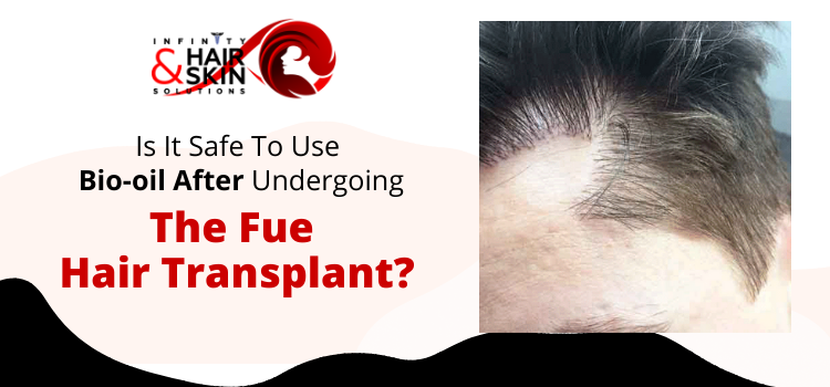 Is it safe to use bio-oil after undergoing the FUE hair transplant?